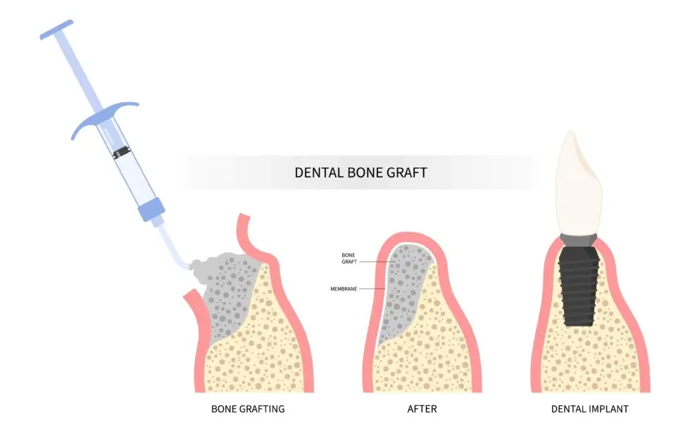 durability of dental bone grafts