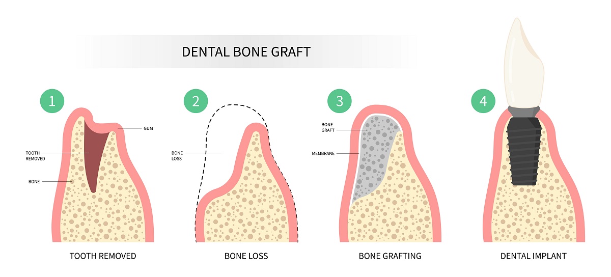how can bone grafting aid dental implants